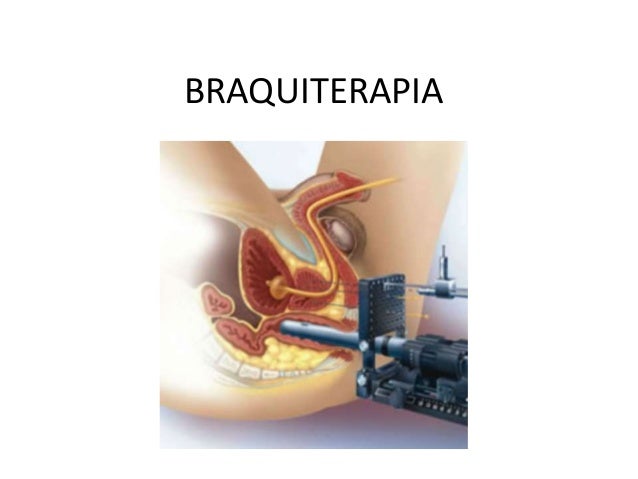 braquiterapia ginecologica